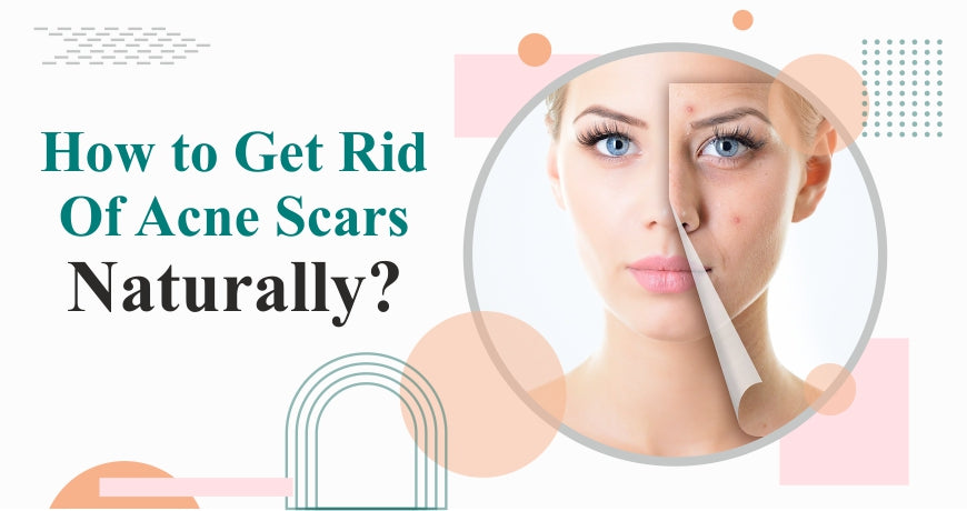 How to Get Rid of Acne Scars Naturally?