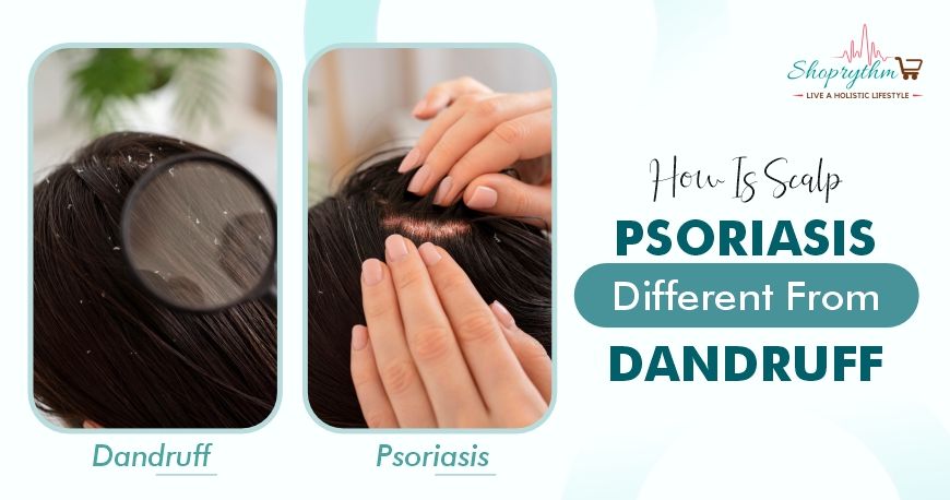 Scalp Psoriasis vs. Dandruff