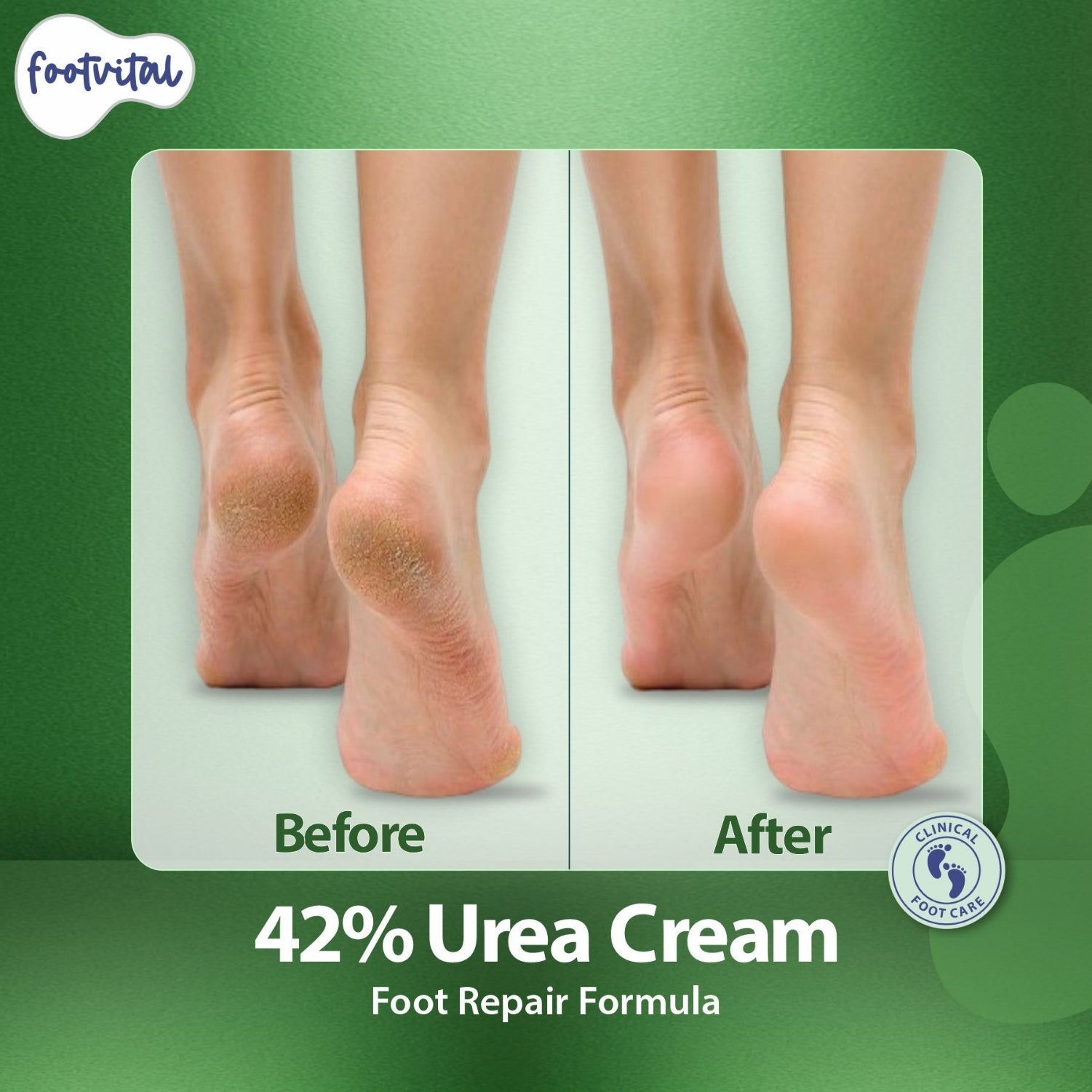 Shoprythm New Arrival,footvital Foot cream with Urea 42%